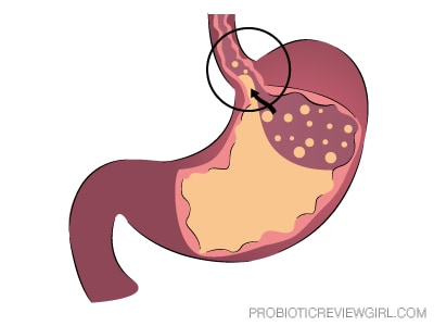 Acid-Reflux_Graphic