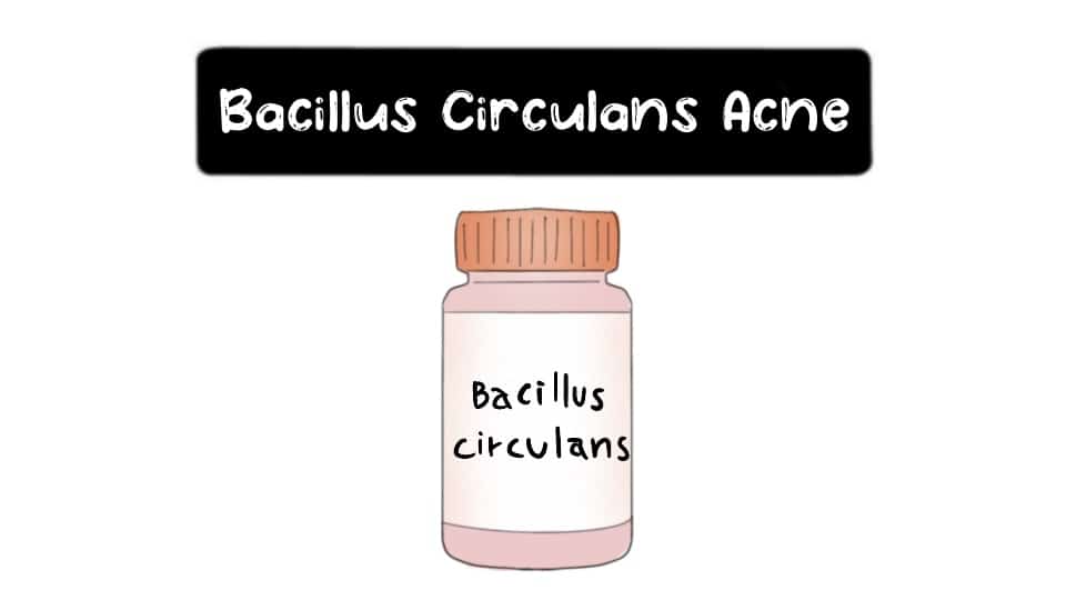 Bacillus-Circulans-Acne-Thumbnail