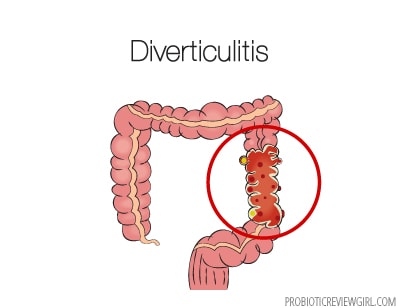 Diverticulitis_graphic