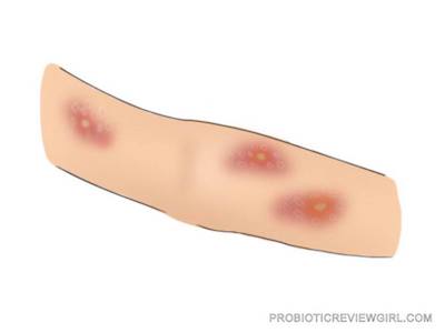 Eczema-Arm-Graphic