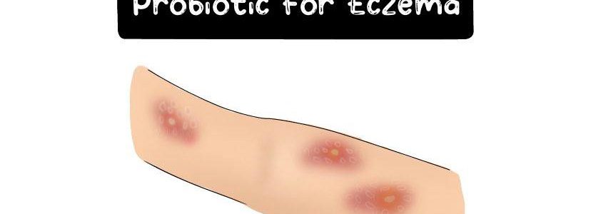 Eczema-Probiotic-Thumbnail