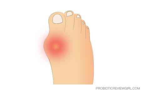 Gout-Toe-Joint-Drawing