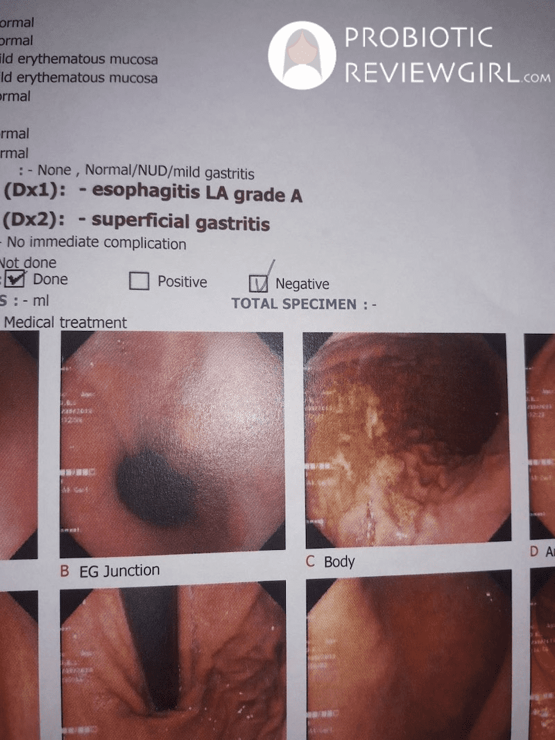 My-Gastritis-Gastroscopy