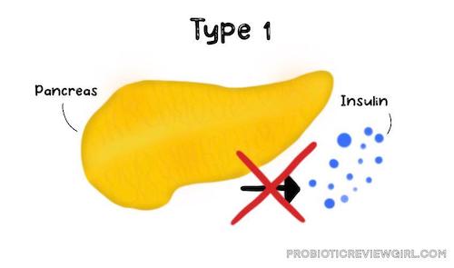 Type-1-Diabetes