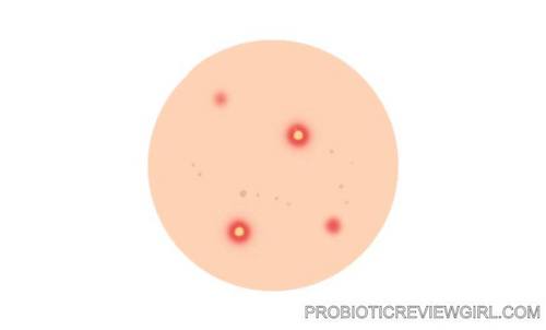 acne-vulgaris-graphic