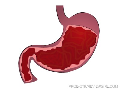 gastritis_graphic